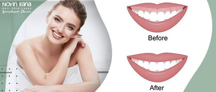 بوتاکس برای لبخند لثه ای